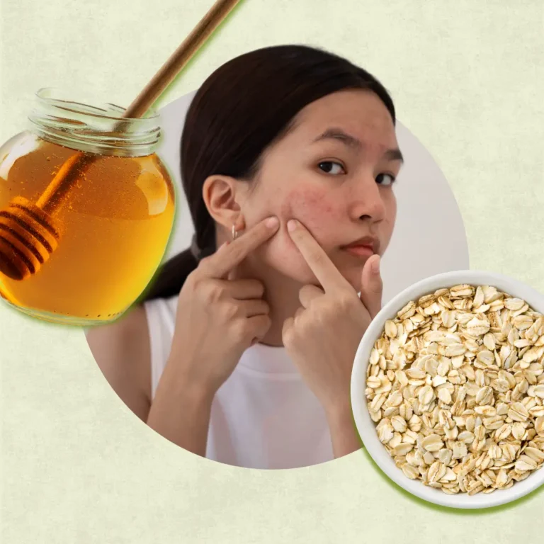 Easy Homemade Face Masks For Acne