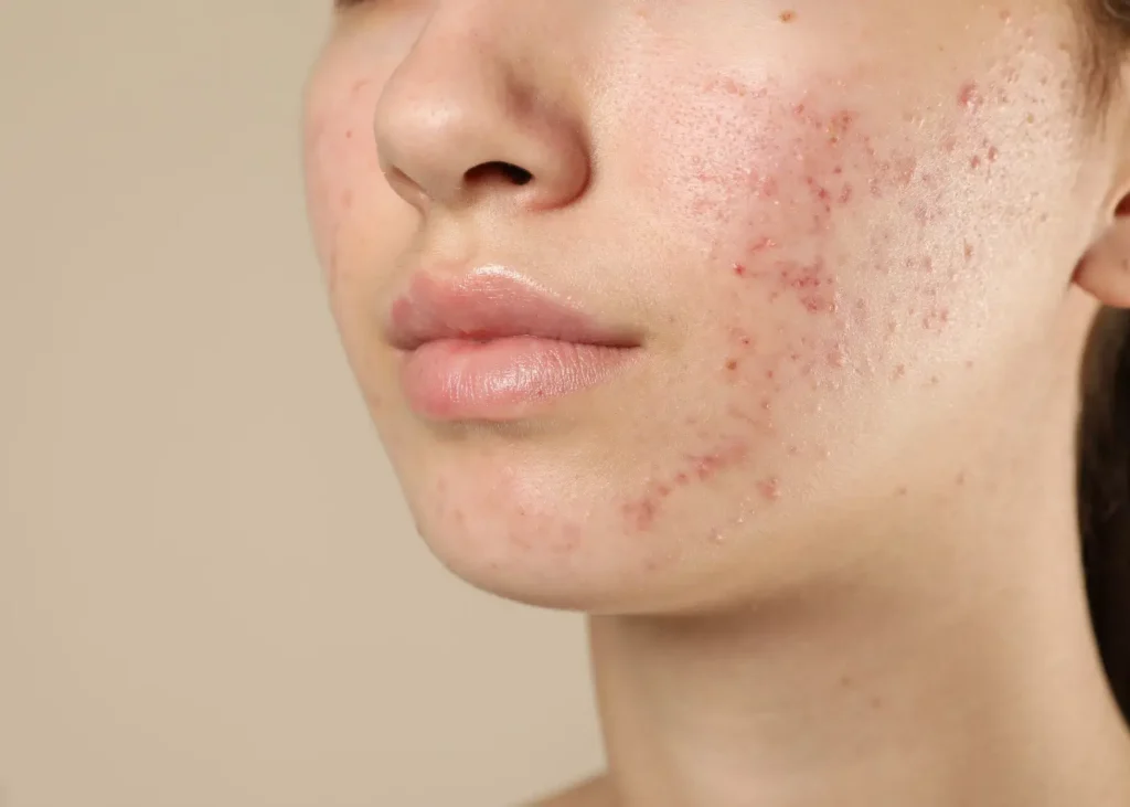 Teenage Girl with Acne Problem on Beige Background, Closeup